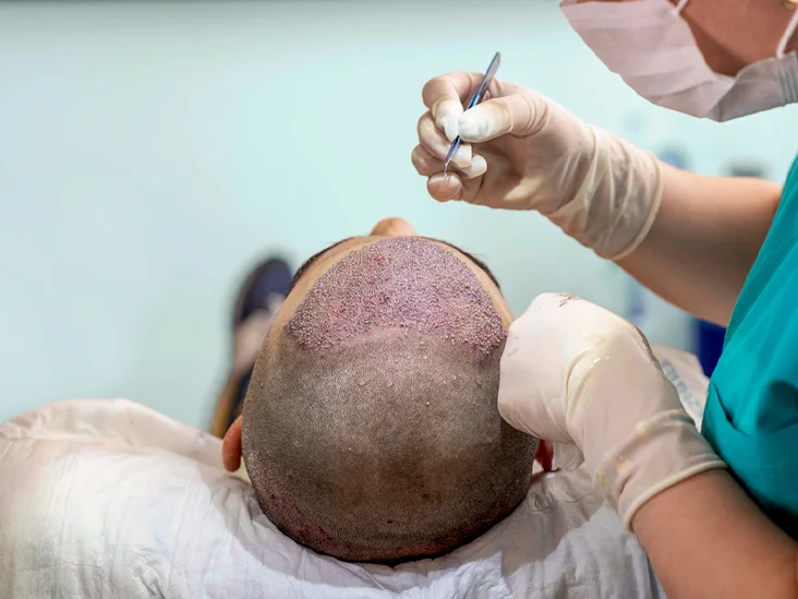 What You Need To Know About The Follicular Unit Extraction Hair Transplant